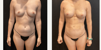 Case 7411 - 35-44 year old woman treated with Abdominal Etching, Brazilian Butt Lift, Breast Fat Transfer