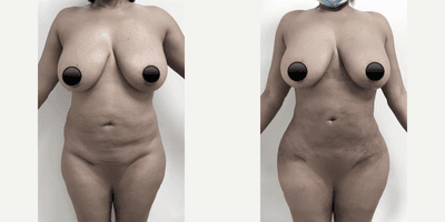 Case 7416 - Woman treated with Brazilian Butt Lift