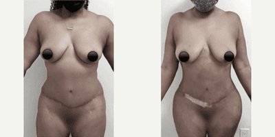 Case 7417 - Woman treated with Brazilian Butt Lift