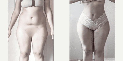 Case 7418 - Woman treated with Brazilian Butt Lift