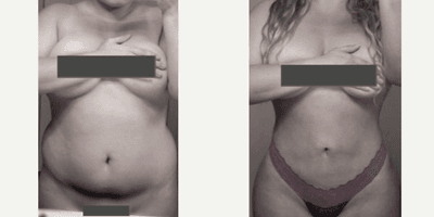 Case 7420 - Woman treated with Brazilian Butt Lift