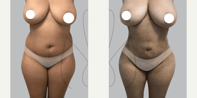 Case 7422 - Woman treated with Brazilian Butt Lift