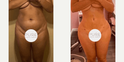 Case 7425 - Woman treated with Brazilian Butt Lift