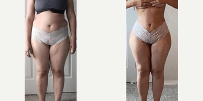 Case 7426 - Woman treated with Brazilian Butt Lift