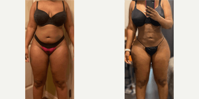 Case 7427 - Woman treated with Brazilian Butt Lift