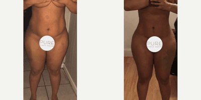 Case 7428 - Woman treated with Brazilian Butt Lift