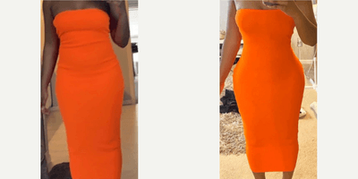 Case 7430 - Woman treated with Brazilian Butt Lift