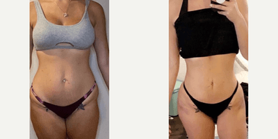 Case 7434 - Woman treated with Brazilian Butt Lift