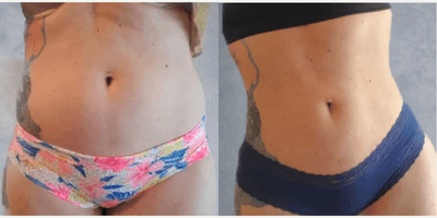 Case 7435 - Woman treated with Brazilian Butt Lift