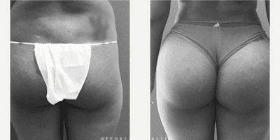 Case 7450 - Woman treated with Brazilian Butt Lift