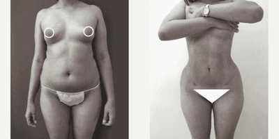 Case 7451 - Woman treated with Brazilian Butt Lift