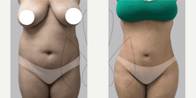 Case 7453 - Woman treated with Brazilian Butt Lift