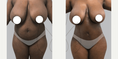 Case 7454 - Woman treated with Brazilian Butt Lift