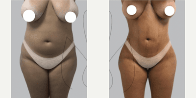 Case 7455 - Woman treated with Brazilian Butt Lift