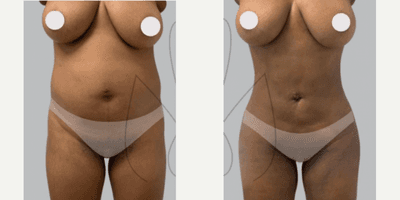 Case 7456 - Woman treated with Brazilian Butt Lift