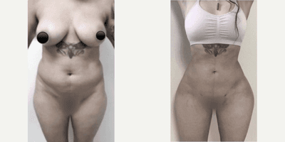 Case 7459 - Woman treated with Brazilian Butt Lift