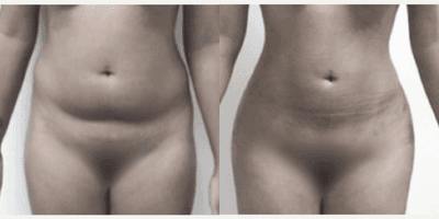 Case 7462 - Woman treated with Brazilian Butt Lift