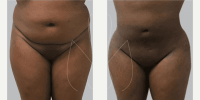 Case 7463 - Woman treated with Brazilian Butt Lift