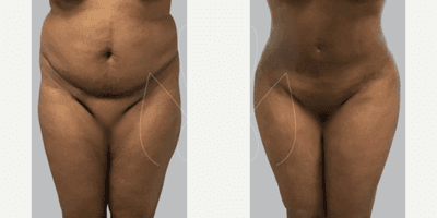 Case 7466 - Woman treated with Brazilian Butt Lift