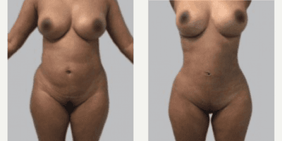 Case 7467 - Woman treated with Brazilian Butt Lift