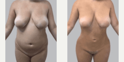 Case 7472 - Woman treated with Brazilian Butt Lift