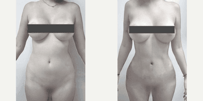 Case 7473 - Woman treated with Brazilian Butt Lift