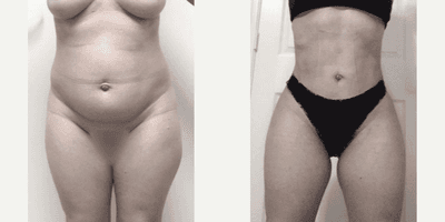 Case 7474 - Woman treated with Brazilian Butt Lift