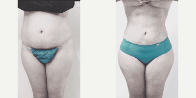 Case 7475 - Woman treated with Brazilian Butt Lift