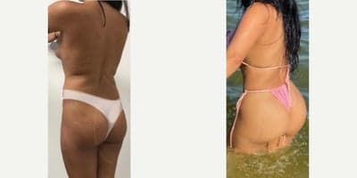 Case 7494 - Woman treated with Brazilian Butt Lift