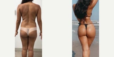 Case 7495 - Woman treated with Brazilian Butt Lift