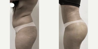 Case 7496 - Woman treated with Brazilian Butt Lift