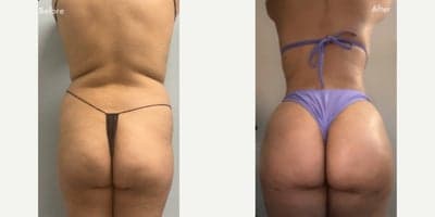 Case 7497 - Woman treated with Brazilian Butt Lift