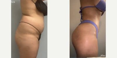 Case 7498 - Woman treated with Brazilian Butt Lift