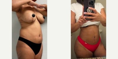 Case 7499 - Woman treated with Brazilian Butt Lift