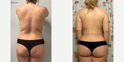 Case 7502 - Woman treated with Brazilian Butt Lift
