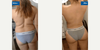 Case 7513 - Woman treated with Brazilian Butt Lift
