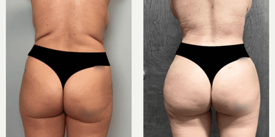 Case 7515 - Woman treated with Brazilian Butt Lift