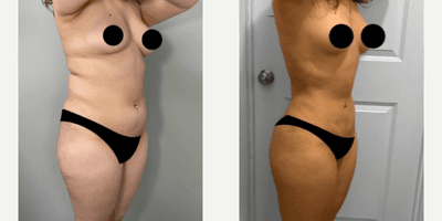 Case 7516 - Woman treated with Brazilian Butt Lift