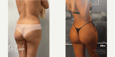 Case 7518 - Woman treated with Brazilian Butt Lift