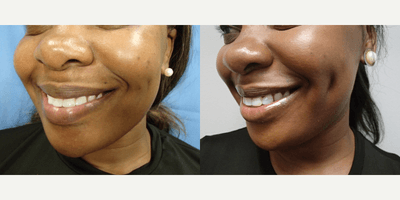 Case 7523 - 35-44 year old woman treated with Dimple Surgery