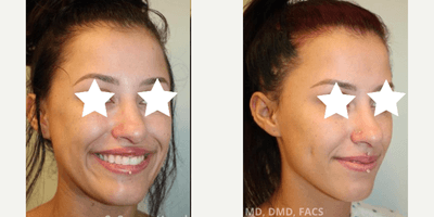 Case 7525 - 25-34 year old woman treated with Dimple Surgery