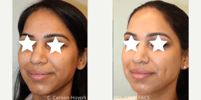 Case 7526 - 25-34 year old woman treated with Dimple Surgery