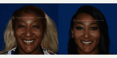 Case 7527 - Dimpleplasty