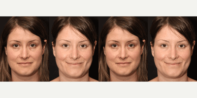 Case 7528 - 25-34 year old woman treated with Dimpleplasty