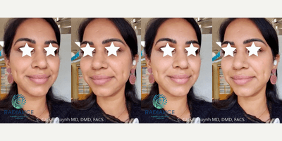 Case 7531 - 25-34 year old woman treated with Dimple Surgery