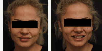 Case 7534 - 25-34 year old woman treated with Dimpleplasty