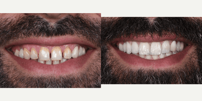 Case 7582 - 35-44 year old man treated with Porcelain Veneers, Lumineers, Smile Makeover, Zoom Whitening