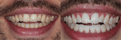 Case 7583 - 25-34 year old man treated with Zoom Whitening