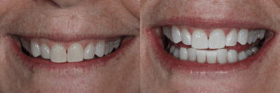 Case 7584 - 65-74 year old woman treated with Zoom Whitening