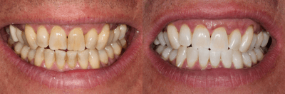 Case 7585 - 45-54 year old man treated with Zoom Whitening